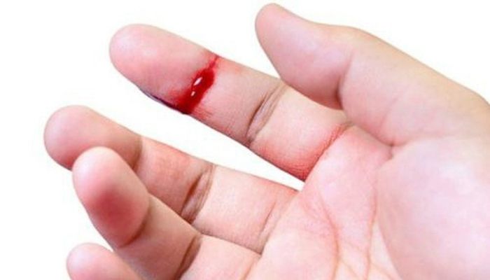 đứt tay chảy máu đánh con gì