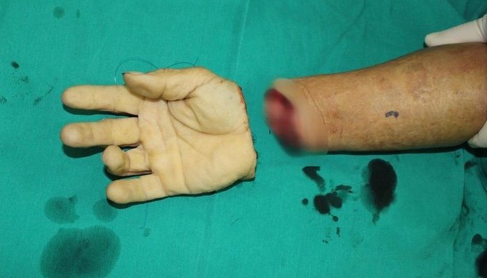 đứt tay chảy máu đánh con gì